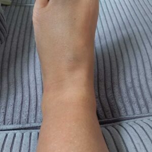 Broken ankle